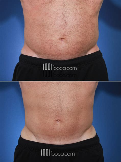 CoolSculpting® Before and After Photo Gallery .